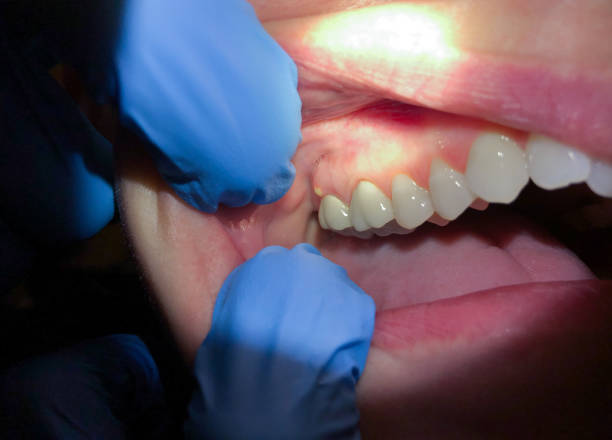Best Emergency Gum Treatment in Lexington, TX